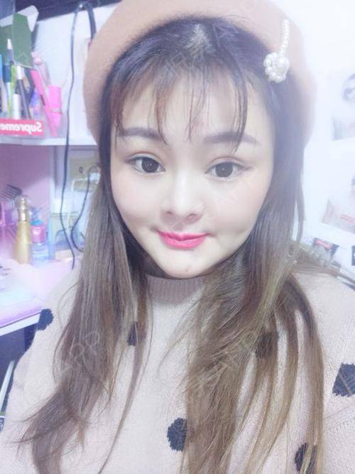 现在看上去更加的自然啦,化上淡妆感觉就是萌萌哒少女...垫鼻基底悦美整形