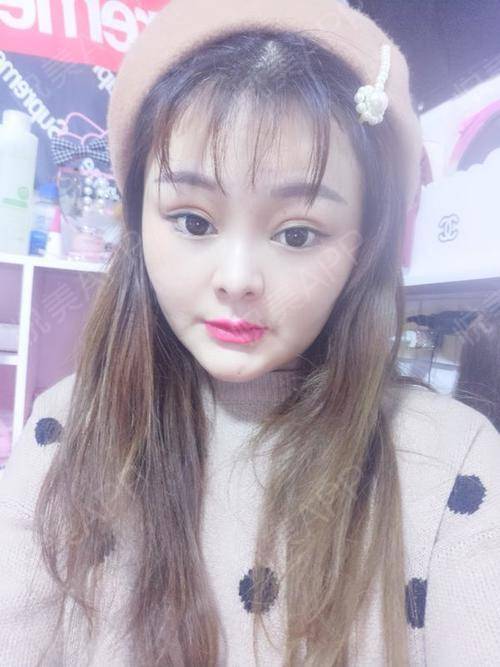 现在看上去更加的自然啦,化上淡妆感觉就是萌萌哒少女...垫鼻基底悦美整形
